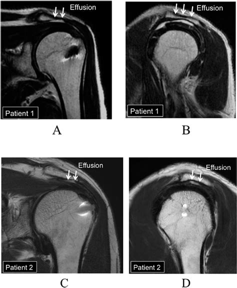 special tests for rotator cuff tear vs mri|rotator cuff muscles mri anatomy.